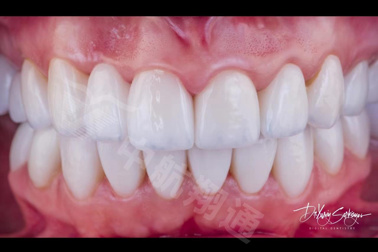XTCERA 3D White 